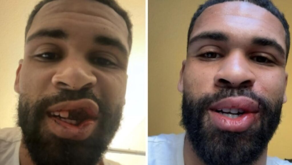 tutti-attorno-a-loftus-cheek-intervento-riuscito-le-foto-prima-e-dopo